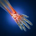 carpal tunnel syndrome