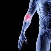 Tennis Elbow